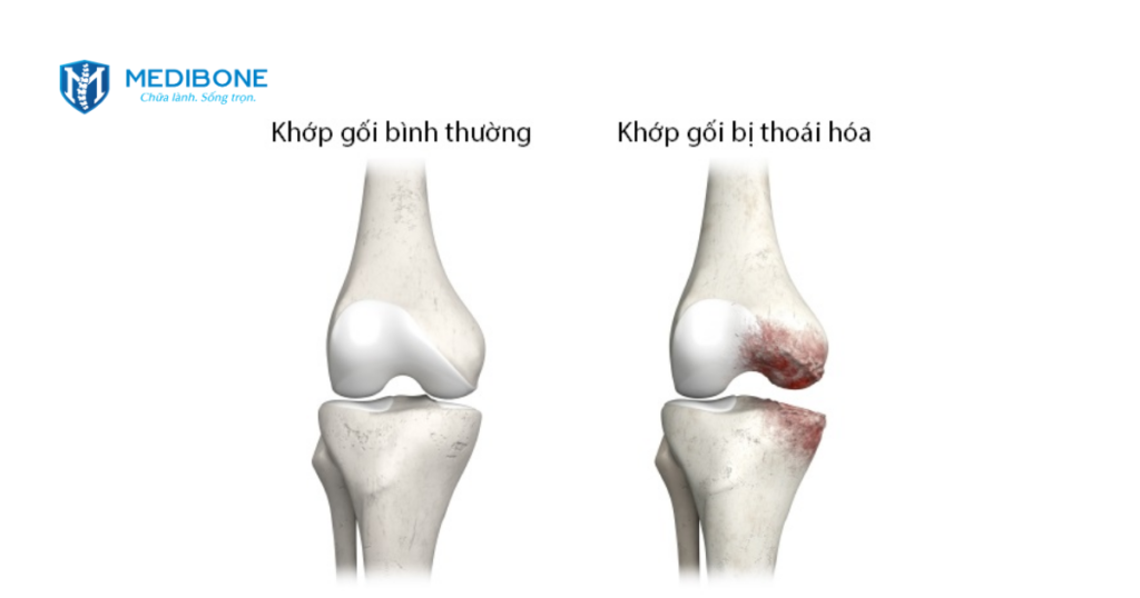 Top 5 Bệnh Xương Khớp Thường Gặp & Cách Nhận Biết 2 thoái hóa khớp gối
