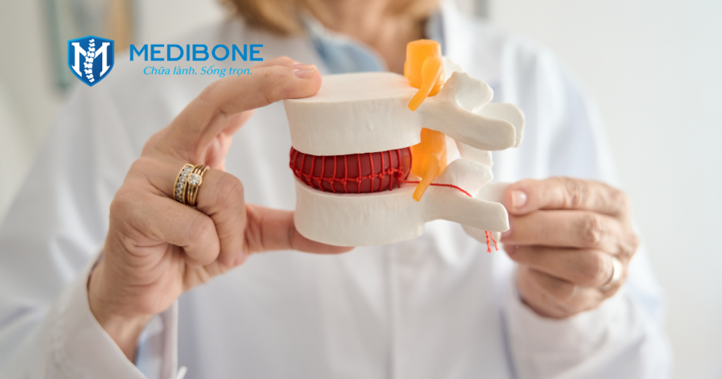 Thoát Vị Đĩa Đệm Thắt Lưng: Đừng Đợi Đến Khi Đau Lan Xuống Chân Mới Đi Khám 2 Thoát Vị Đĩa Đệm Thắt Lưng Là Gì?